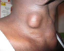 Thyroid cancer is a cancerous condition of the thyroid gland which is located in the throat, just below the voice box. Thyroid Nodules What Is It Symptoms Causes Prevention And Treatment Top Doctors