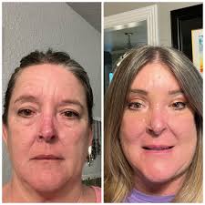 Hello. I am 9 days post op and the lump in my neck from the incision is  solid to the touch. How long can I expect to have the swelling in my