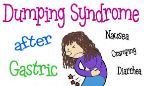 Dumping Syndrome After Gastric Bypass Surgery Is No Fun My Gastric Bypass Story