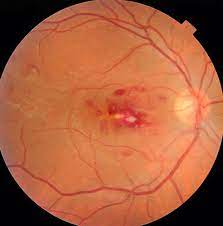 Roth Spots In Infective Endocarditis The Presence Of White Centered Hemorrhages Roth Spots Should Prompt The Consid Eye Health Retinal Photography Optometry