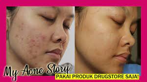 Jual beli online aman dan nyaman hanya di tokopedia. My Acne Story Mengatasi Kulit Berjerawat Dengan Produk Drugstore Youtube