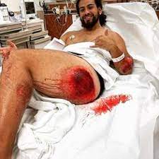 110 Road Rash Ideas In 2021 Road Rash Rashes Road Rash Treatment