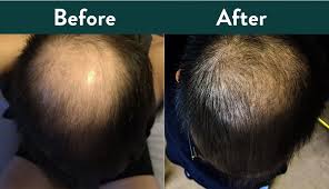 For women, an underactive thyroid can be one of the factors contributing to hair loss, but in most cases, for both men and women, androgenic alopecia occurs because of a genetically determined shortening of anagen, a hair's growing phase, and a lengthening of the time between the shedding of a hair and the start. Success Story Jordan S Hair Regrowth Manual