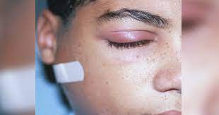 Girl Develops Lump In Axillary Area Fever