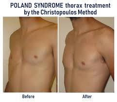 It is a birth defect with a variety of associated anomalies occurring around the upper limbs and torso. Breast Asymmetry Poland Syndrome Cosmetic Plastic Surgery Abroad
