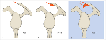 In human anatomy, the acromion (from greek: Shoulder Joint Radiology Key