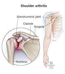 Image result for Shoulder History