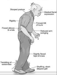 Image result for Extrapyramidal Side Effect