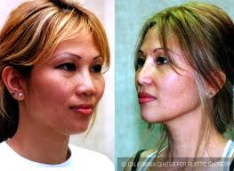 Jacono understands the asian nose and has a specialized approach to each. Patient 6379 Asian Rhinoplasty Before And After Photos Beverly Hills Plastic Surgery Gallery Los Angeles Ca Dr Sean Younai