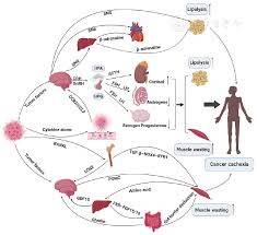 Image result for Cachexia in Cancer