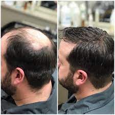 Hairskeen Men S Hair Loss Transformation Hair Loss Men Reduce Hair Loss Hair Loss Solutions