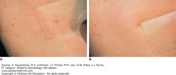 Image result for Diascopy