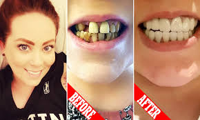 Reviewed in the united kingdom on december 16, 2015. Woman Who Spent 5 500 On A Whole Mouth Reconstruction In Bali Shares Photos Daily Mail Online