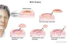 Image result for how to make black salve cancer treatment