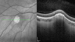 Image result for lesion sclera