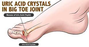 What is uric acid?uric acid is a compound that gets produced when food breaks down. How To Quickly Remove Uric Acid Crystallization From Your Body To Prevent Gout And Joint Pain å›½é™… è›‹è›‹èµž