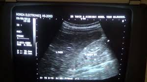 The grades are used by doctors to estimate the severity of the changes on ultrasound with grade 1 being mild and grade 4 being severe. Grade 2 Bilateral Renal Parenchymal Changes Youtube