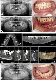 Numb Chin With Mandibular Pain Or Masticatory Weakness As Indicator For Systemic Malignancy A Case Series Study Sciencedirect