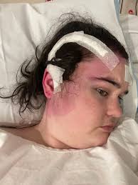 Living with a brain tumor and skull hole