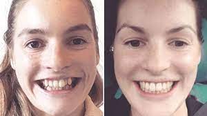We reviewed the best dental insurance for braces based on plan availability, cost, coverage, and more. Adult Braces Why Are More Grown Ups Getting Their Teeth Straightened Bbc News