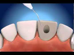 It usually takes a week to completely recover from a root canal treatment. Root Canal Therapy Rct The Gentle Dentist Youtube