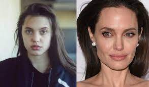 Veja como é o resultado desse procedimento: Antes E Depois Da Bichectomia Rinoplastia Cirurgia Famosos