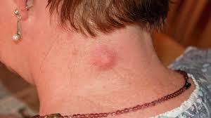For example, lumps that form in the armpit are. Hard Lump Under Skin 8 Causes And How They Re Treated