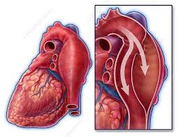 Image result for Aortic Dissection
