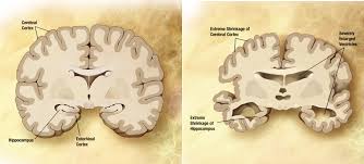 alzheimers disease wikipedia