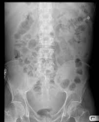 Ascites Radiology Case Radiopaedia Org Radiology Radiography Student Radiography