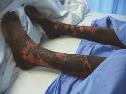 Burn eschar may have different appearances and thicknesses, and may behave in different ways as a function of etiology and time since injury, as well as topical and other treatment modalities. Burn Injuries Thoracic Key