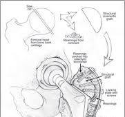 The Use of Locking Plates for Greater Trochanteric Fixation ...
