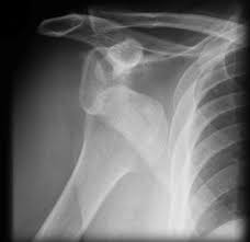 Image result for Shoulder Relocation Maneuvers