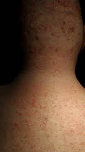 Pimples, bumps, and cyst that come up when i shave my bikini area. Ingrown Hair Ingrown Hair Scars Reddit