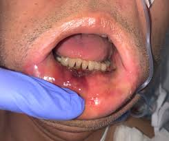 Necrotizing fasciitides) refers to a rapidly progressive and often fatal aggressive necrotizing soft tissue infection primarily involving and spreading along the fascia. Diagnosing Necrotizing Fasciitis