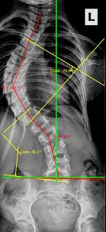 متى يلجأ الطبيب إلى جراحة اعوجاج العمود الفقري؟