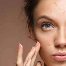 5 Causes Of Pimples That You Should Know Https Ift Tt 2amoobx In 2020 Pimple Causes Pimples What Is A Pimple
