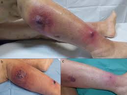 Image result for Pyoderma Gangrenosum
