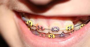 Black And Light Purple Braces Purple Light Orange And Neon Yellow Brackets Dentales Brackets Ligas Para Brackets