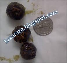 Ada yang mengatakan kesan buang rahim atau histerektomi akan mengakibatkan penurunan berat badan. Kenapa Dan Kesan Hempedu Di Buang Based On True Story