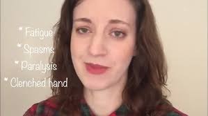 Post-infectious Myalgic Encephalomyelitis/Chronic Fatigue Syndrome