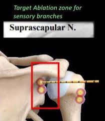 Image result for Radiofrequency Surgery