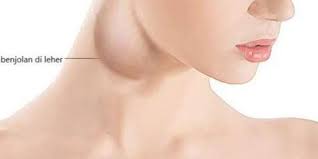 Bahayakah benjolan di leher ?? Klinik Avicenna Benjolan Di Leher Punca Simptom Dan Facebook