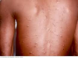 Image result for Varicella zoster on human skin