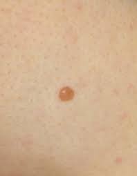 Image result for Spitz Nevus