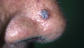 skin condition where the skin loses pigment or color. The Two Most Common Forms Of Skin Cancer Clinical Advisor
