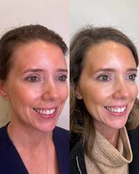 another gorgeous result with neurotoxin. when placement is precise,  neurotoxin looks effortless & natural. we treated masseters here as well,  and you can see the slimming starting to take effect and that