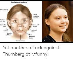 Skin tags in front of eyes; Fetal Alcohol Syndrome Microcephaly Small Palpebral Fissures Railroad Irackears Epicanthal Folds Low Nasal Bridge Flat Midface Upturned Nose Smooth Philtrum Thin Vermilion Border Underdeveloped Yet Another Attack Against Thurnberg At Rfunny