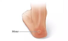 Use 7 tactics to prevent foot blisters when running or walking. How Do I Treat Blisters On My Feet Florida Foot Ankle Treatment Center