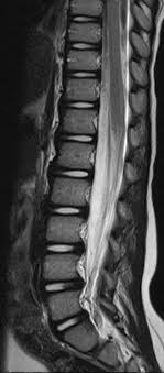 Weakness and tingling in your extremities are usually the first symptoms. Guillain Barre Syndrome Radiology Case Radiopaedia Org